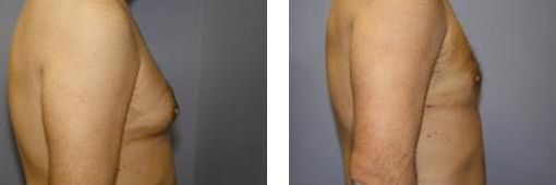 Männerbrust vor und nach der Injektions-Lipolysebehandlung